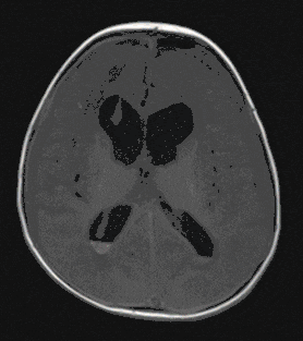 Medulloblastom Medulloblastom